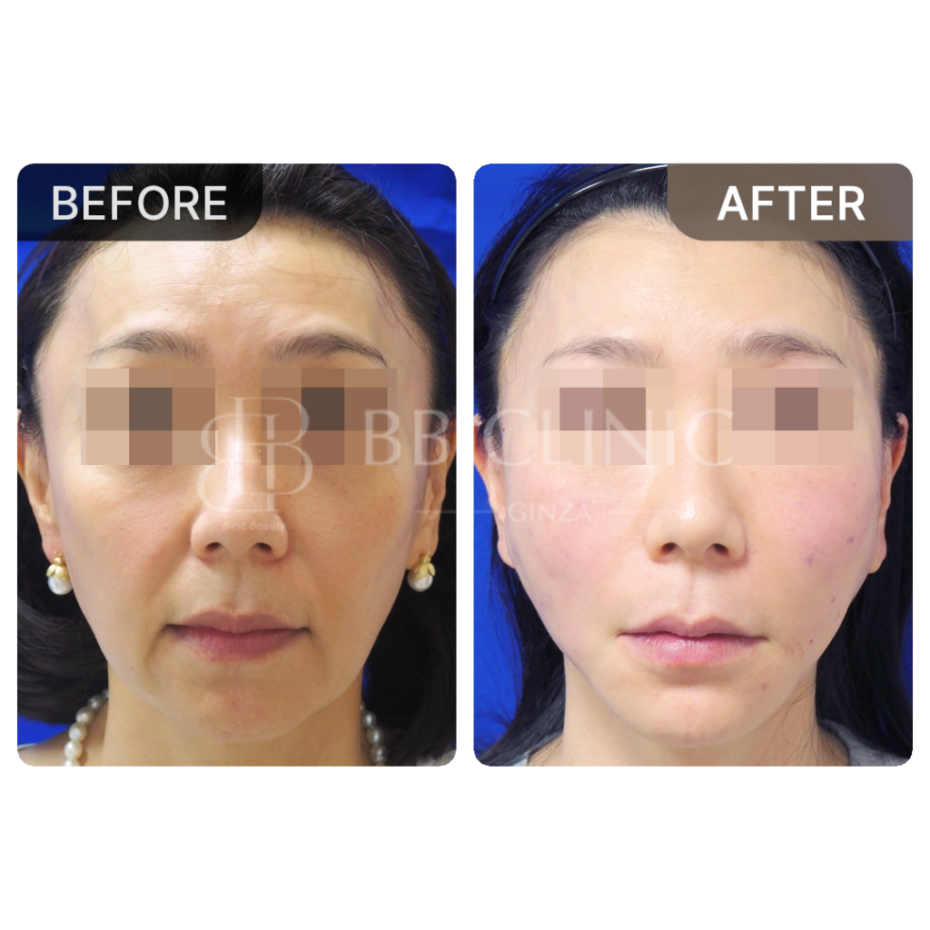 ミント糸リフティング