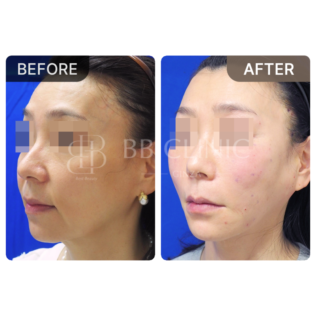 ミント糸リフティング