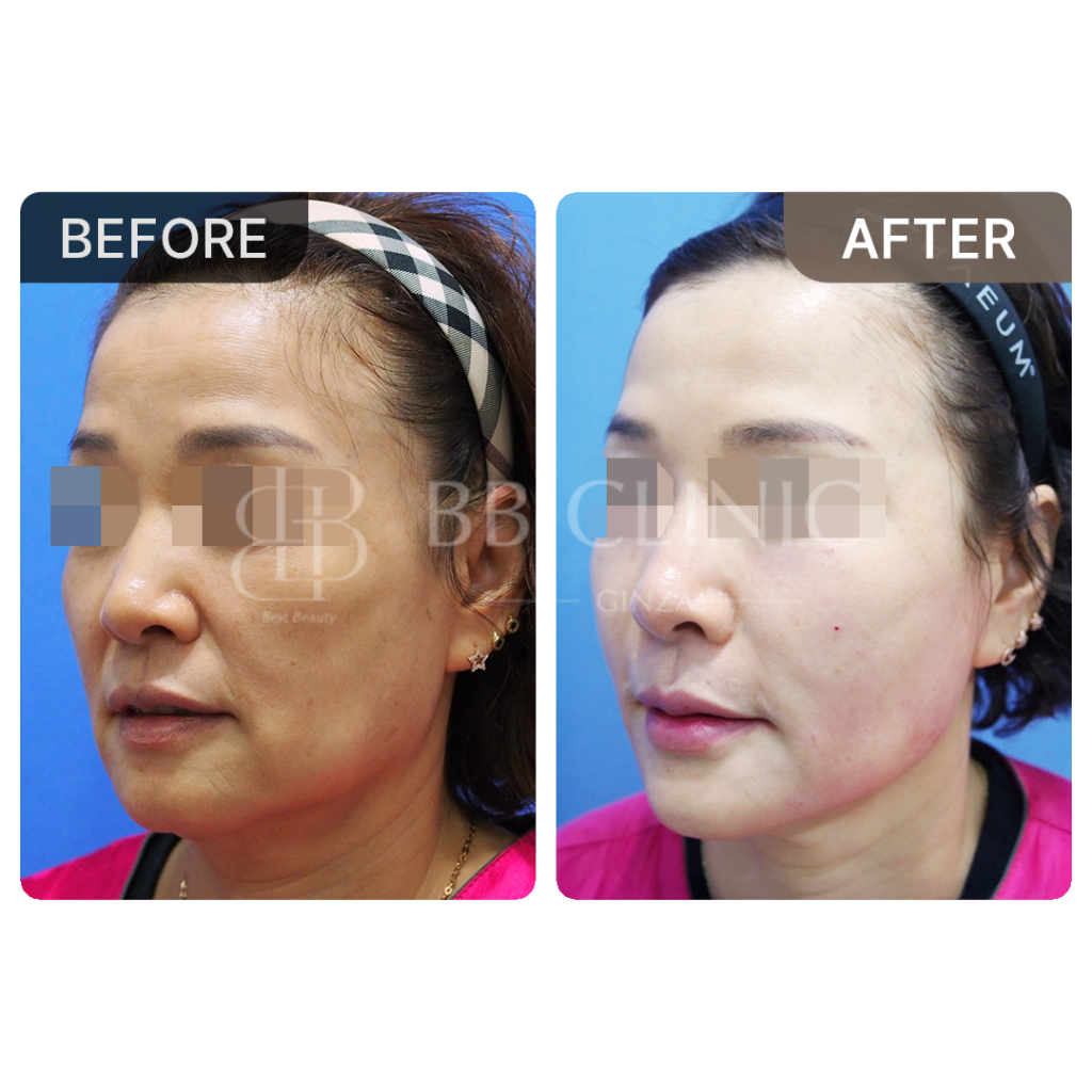 ミント糸リフティング