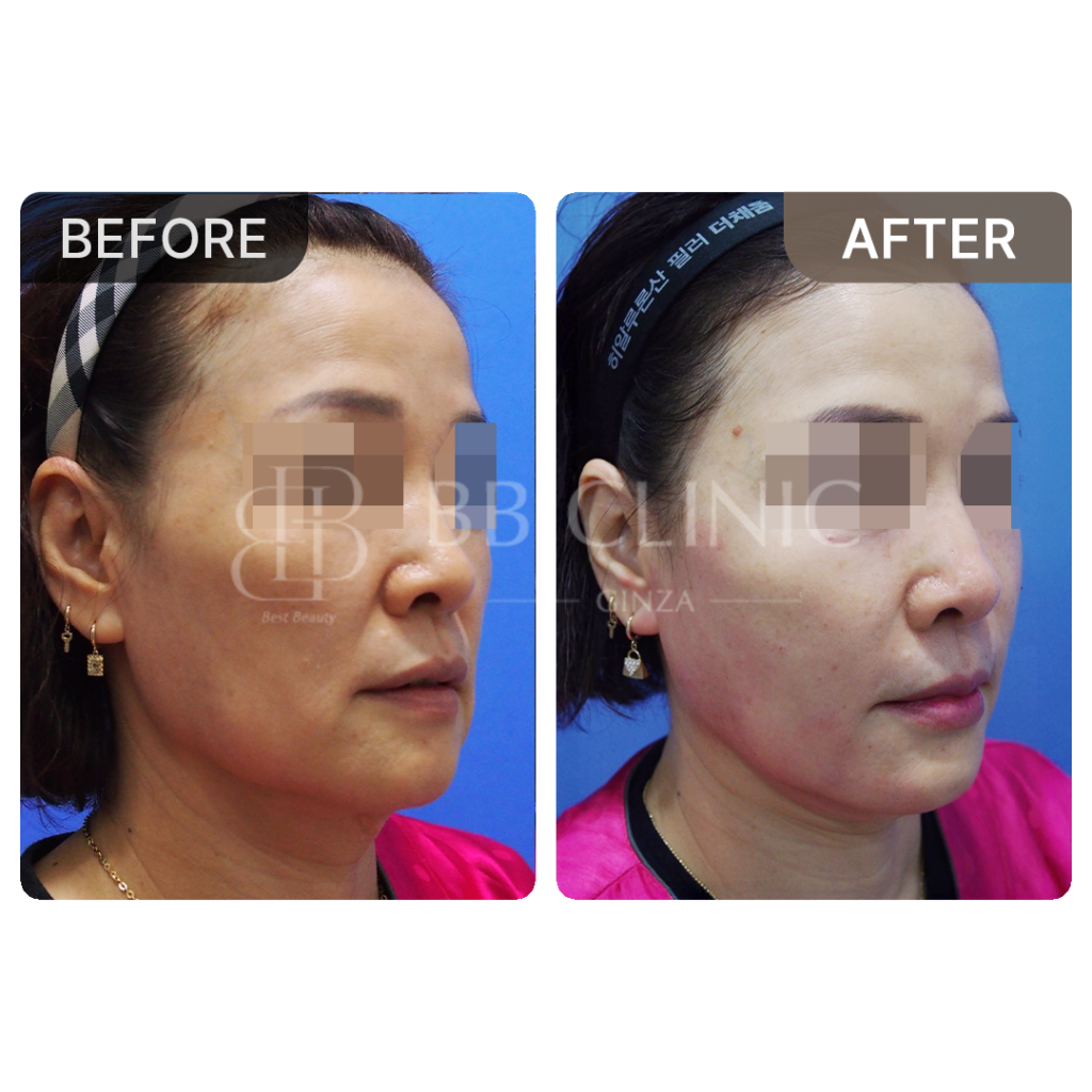 ミント糸リフティング